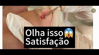 VÍDEO SATISFATÓRIO UNHA ENCRAVADA #ingrowntoenail #nails #satisfying #satisfacao #unhaencravada