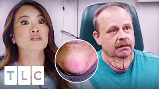 Dr Lee Is Scared To Operate On Patient Who Could Get Paralysed  Dr. Pimple Popper This Is Zit