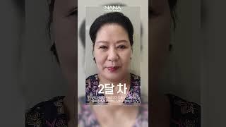 눈썹거상 풀페이스리프팅 얼굴지방흡입 후기