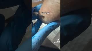 Painful Heel Porokeratosis Removal