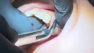 Extraction for First Maxillary Premolar