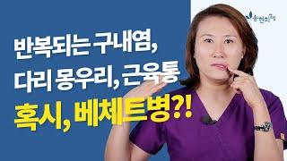 구내염이 반복된다면? 베체트병의 원인과 진단 치료관리법 ft. 혈관염