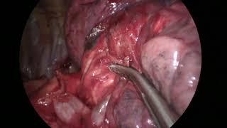 Asvide Intraoperative video of left uniportal subxiphoid video-assisted trisegmentectomy.