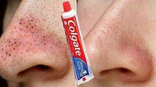 Blackheads  Whiteheads 100% working Home Remedy  Easy way to treat blackheads and whiteheads