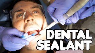 Dental Sealant Procedure