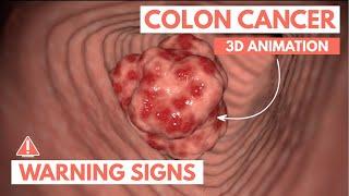 5 warning signs of Colon Cancer  3D Animation