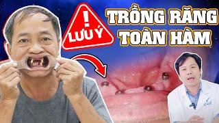 Trồng Răng Toàn Hàm All On 4 5 Lưu Ý Không Được Quên Tránh Mất Tiền Oan Khi Trồng Răng Toàn Hàm