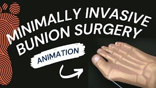 Minimally Invasive Bunion Surgery A Short Animation