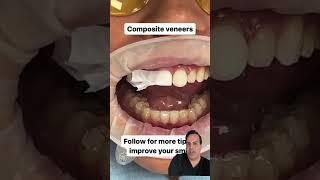 Composite veneers to change your smile#veneers#cosmeticdentistry#smile#beforeandafter