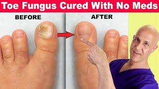 Toe Nail Fungus Cured With No Meds  Dr. Mandell