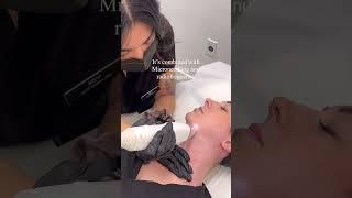 Transform Your Skin with Potenza RF Microneedling at SEV