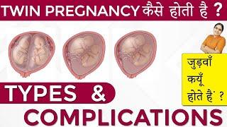 Twins Pregnancy Types Dichorionic Conjoined Monochorionic Diamniotic Monochorionic Monoamniotic