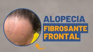 Entenda tudo sobre a Alopecia Fibrosante Frontal