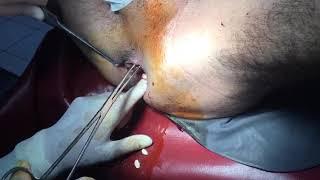 Anal  Rectal foreign body  surgical removal of foreign rectal foreign body  medico mnemonico