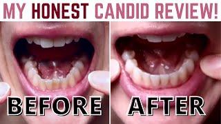 My Experience Straightening My Teeth at Home with Candid Clear Aligners Brutal Honesty 