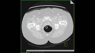 Virtual colonoscopy in 2D and small rectal polyp