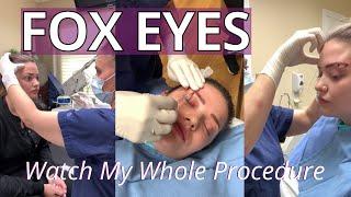 Watch My Foxy Eyes Thread Lift  See the Whole Thing Start to Finish 