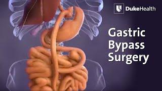 Gastric Bypass Surgery  Duke Health