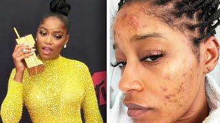 Keke Palmer Opens Up About Her Struggle With Acne