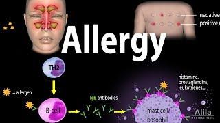 Allergy - Mechanism Symptoms Risk factors Diagnosis Treatment and Prevention Animation