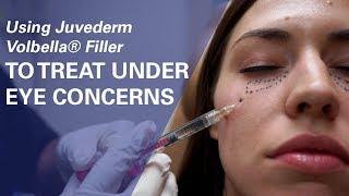 Using Juvederm  Volbella® Filler To Treat Under-Eye Concerns at ZO Skin Centre