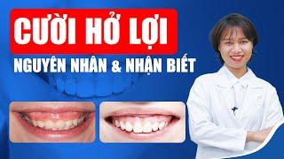 Cười Hở Lợi - Nguyên Nhân Và Cách Nhận Biết  Nam Bùi Vinalign