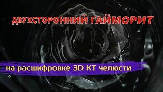 ДВУХСТОРОННИЙ ГАЙМОРИТ на снимке 3D КТ зубов и челюсти при РАСШИФРОВКЕ КТ второе мнение