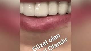 Zirkonyum Kaplama İle Estetik Gülüş Tasarımı