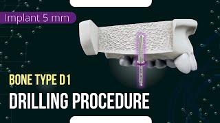 Drilling procedure for XGate Dental X11 and X3 Pure&Porous Implant 5 mm diameter bone type D1