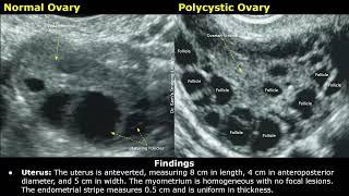 Polycystic Ovarian Syndrome PCOS Ultrasound Report Example  How To Write Gynecological USG Report