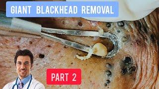 Massive blackhead removal inside a dermatology clinic  @Dr.AMAZINGSKIN