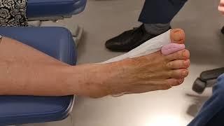 How to Tape After Bunion Surgery