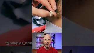 Barber shop pimple pop special #pimplepop #cystpop #dermreacts #doctorreacts