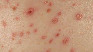 DermTV - How to Remove Chickenpox Scars DermTV.com Epi #382