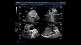 Ultrasound Video showing the Cirrhosis of the liver.