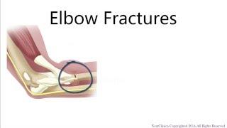 Elbow fracture