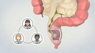 Patient Teaching Low Anterior Resection - Surgical Management of Rectal Cancer  TVASurg