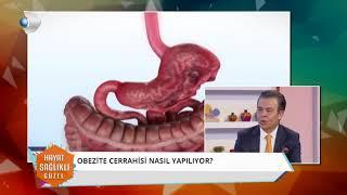 Obezite Cerrahisi Nasıl Yapılır?