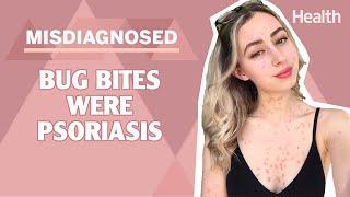 This Womans Psoriasis Was Misdiagnosed as Bug Bites  Misdiagnosed Claire Spurgin  Health.com