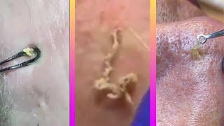 Satisfying and relaxing TikTok pimpleblackhead popping and removing COMPILATION #4