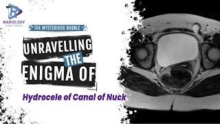 The Mysterious Bubble Unravelling the Enigma of Hydrocele of Canal of Nuck