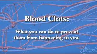 Blood Clot Prevention What You Need to Know About Deep Vein Thrombosis and Pulmonary Embolism