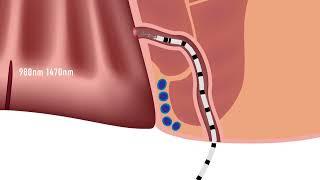 FILAC ALFA Anal Fistula - IBI Healthcare Institute