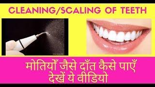 Cleaning & Scaling Hindi हिंदी Deep Cleaning of Teeth