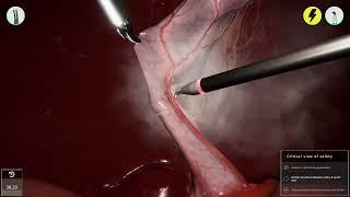 ‍️LAPAROSCOPIC CHOLECYSTECTOMY  Gallbladder removal  3D simulation