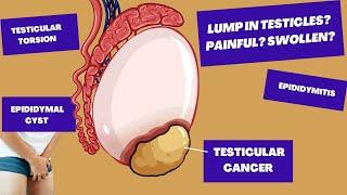Ive found A Lump In My Testicle Could It Be TESTICULAR CANCER?  Causes of Testicular PainLumps