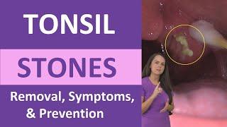 Tonsil Stones Removal Causes Symptoms Cotton Swab Treatment