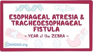 Esophageal atresia & tracheoesophageal fistula Year of the Zebra