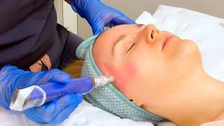 ASMR dermapen micro needling facial with LED