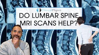 Are MRI Scans Always Helpful in the Diagnosis of Low Back Pain?  Expert Physio Reviews the Evidence